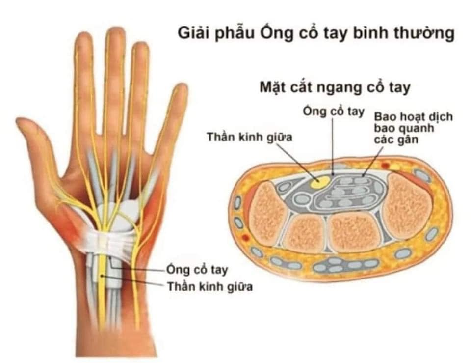 NHỮNG ĐIỀU CẦN BIẾT VỀ HỘI CHỨNG ỐNG CỔ TAY