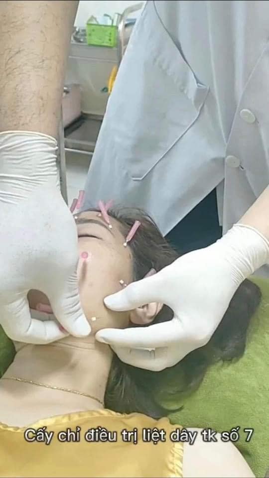 CẤY CHỈ ĐIỀU TRỊ