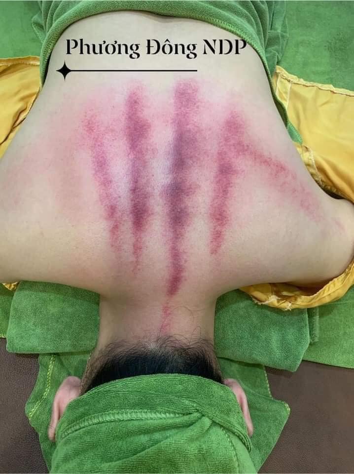 Vì sao tắm đêm dễ đau vai gáy?