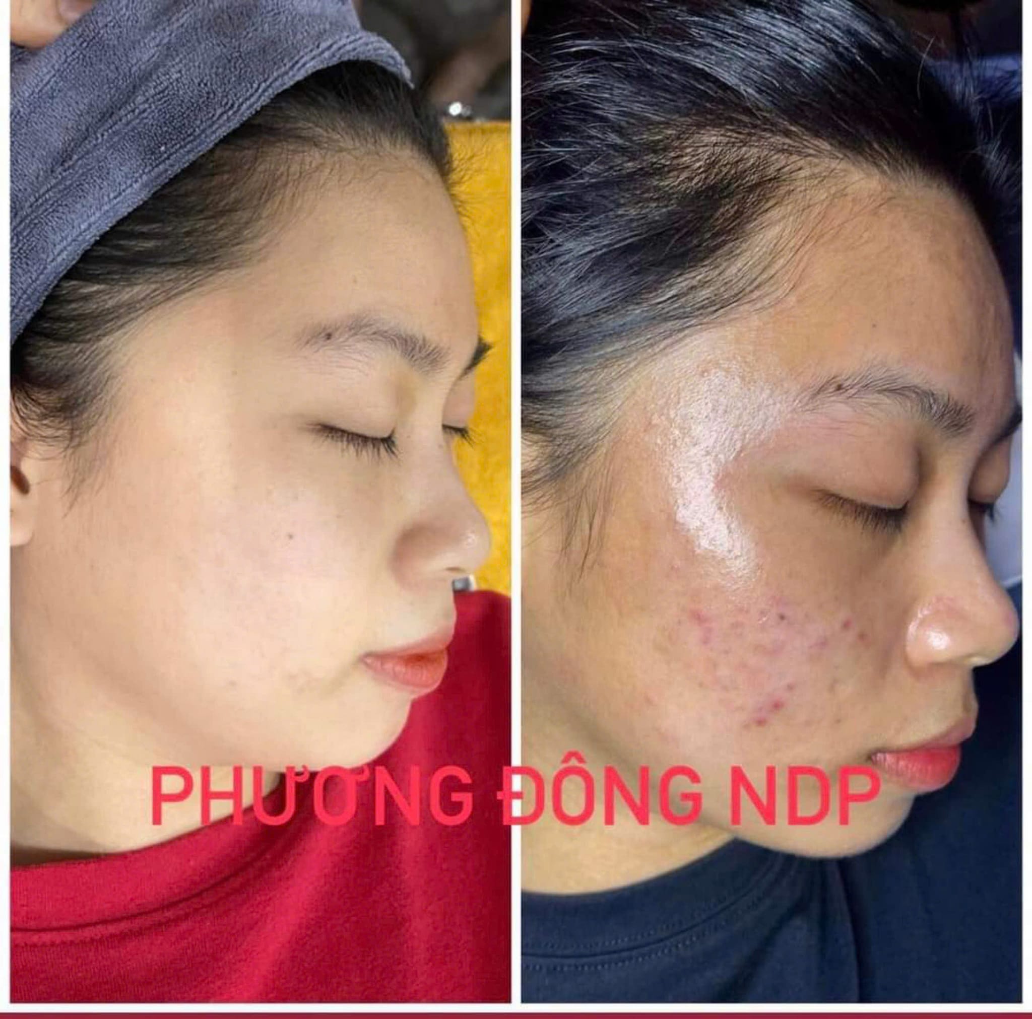 “MỤN” LÀ NỔI ÁM ẢNH, LÀM BẠN THIẾU TỰ TIN !!!