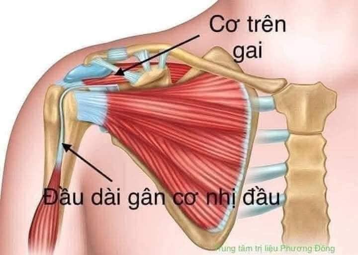 VIÊM QUANH KHỚP VAI