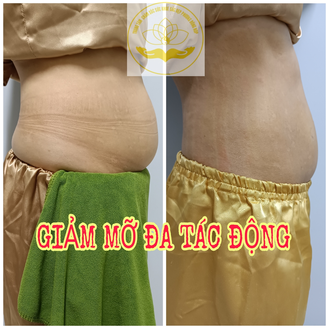 Dịch vụ giảm béo