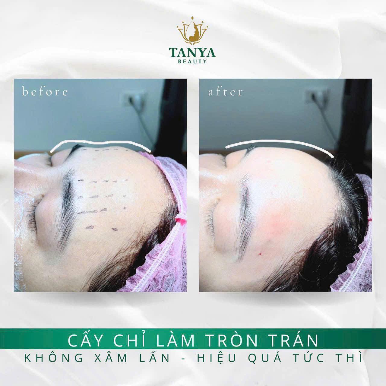 🌟 Cấy chỉ Collagen nội khoa – Giải pháp cho vầng trán đầy đặn, cân đối và phúc hậu 🌟