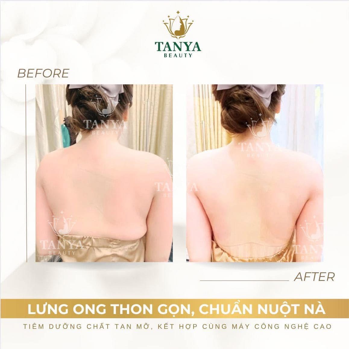 ❓ TIÊM GIẢM MỠ CÓ ĐAU KHÔNG? HIỆU QUẢ KHÔNG?