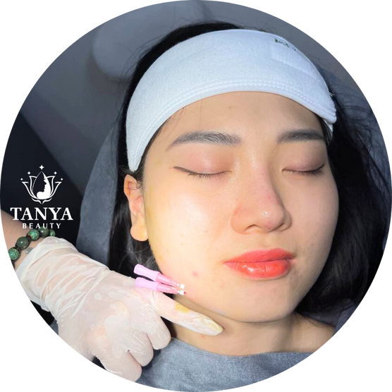Cấy chỉ thẩm mỹ