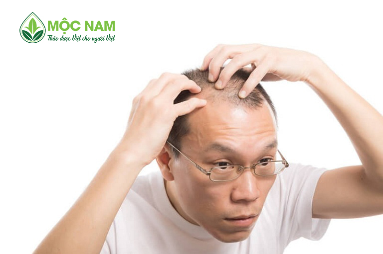 Hói đầu ở nam giới - Nguyên nhân, dấu hiệu, cách điều trị và phòng ngừa