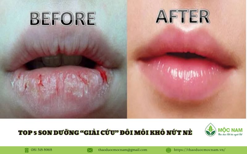 Top 5 son dưỡng “giải cứu” đôi môi khô nứt nẻ