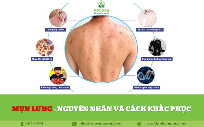 Mụn lưng - Nguyên nhân và cách khắc phục