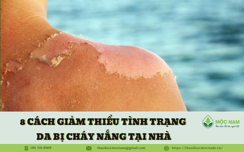 8 Cách giảm thiểu tình trạng da bị cháy nắng hiệu quả ngay tại nhà