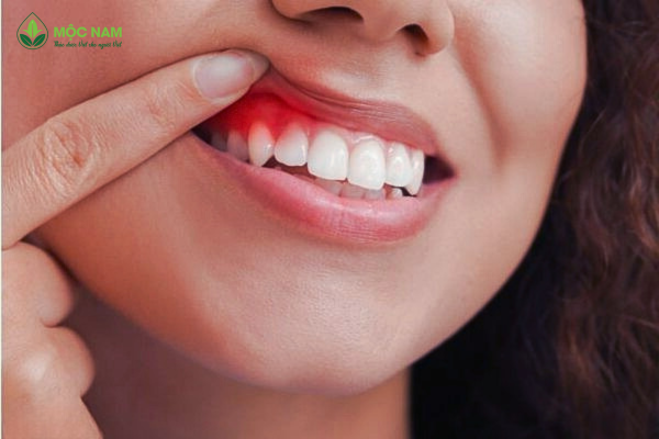 Chảy Máu Chân Răng Và Những Nguyên Nhân Không Ngờ Tới