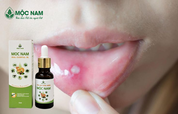 5 Tips Giảm Nhiệt Miệng Nhanh - Hiệu Quả: Giải Pháp Tự Nhiên Từ Mộc Nam