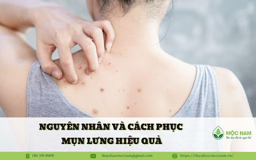 Nguyên nhân và cách phục mụn lưng hiệu quả