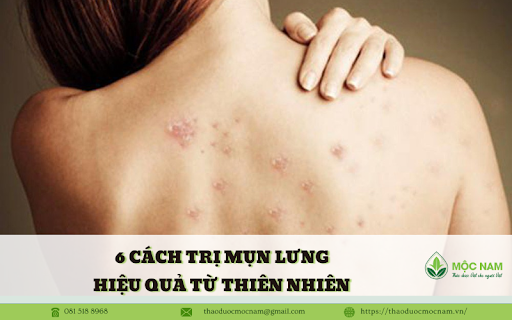 6 Cách trị mụn lưng hiệu quả từ thiên nhiên