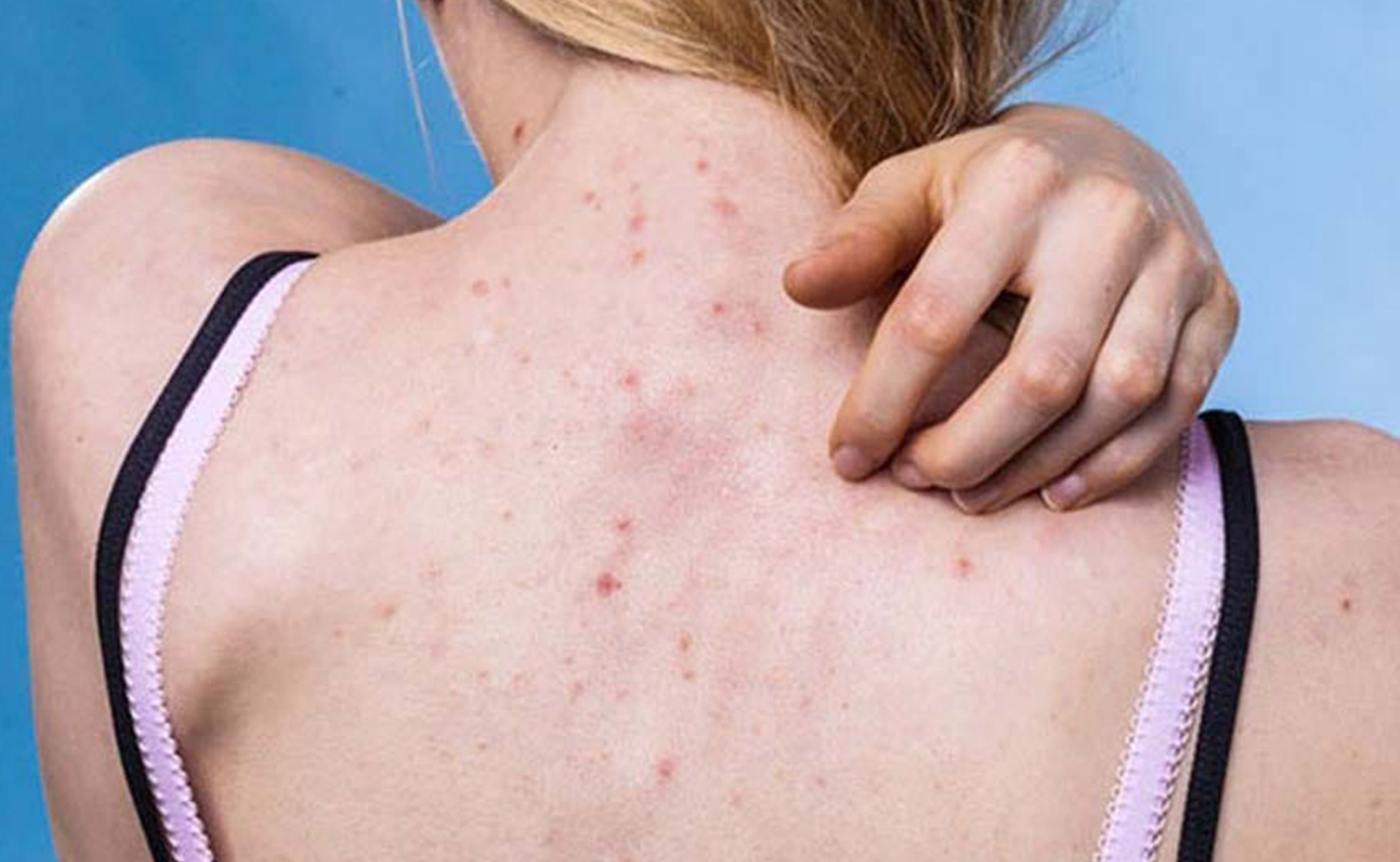 Cách chăm sóc da khi wax lông tránh bị viêm nang lông