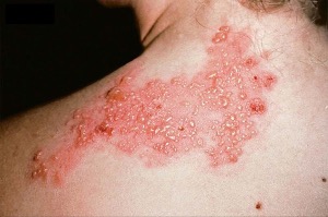 Zona thần kinh: nhận biết triệu chứng và cách điều trị hiệu quả tại nhà