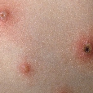 Thủy đậu là gì? Nhận biết và phòng ngừa biến chứng hiệu quả