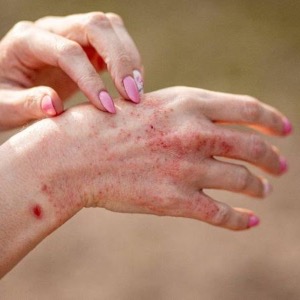 Viêm da cơ địa ở người lớn: Triệu chứng và kinh nghiệm chữa lành hiệu quả