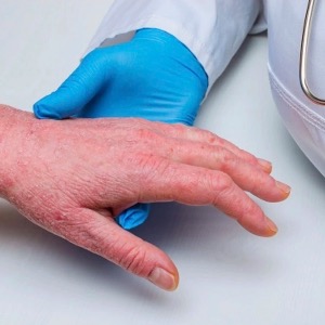 Viêm da cơ địa là gì? các cách điều trị hiệu quả cao