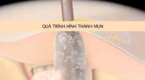 Khám phá công dụng vượt trội của HomoSAN trong chăm sóc da và kiểm soát mụn