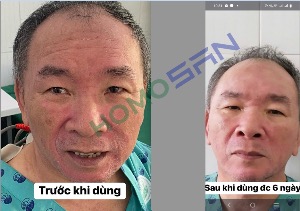 Viêm da cơ địa ở mặt và kết quả tuyệt vời sau 6 ngày sử dụng HomoSAN