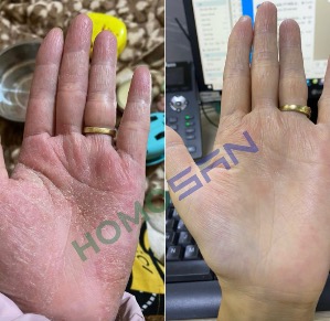 Giảm mạnh viêm da cơ địa ở tay lâu năm với nước muối điện hoá HomoSAN