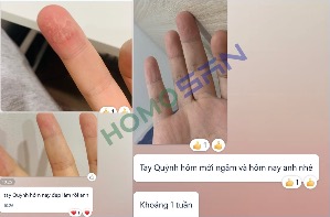 Hình ảnh viêm da cơ địa ngón tay trước và sau khi sử dụng HomoSAN