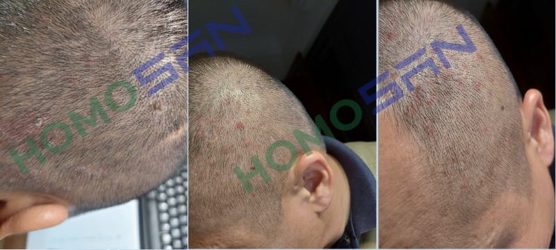 Viêm da cơ địa trên đầu 20 năm và kết quả gây sốc sau 2 tuần khi dùng HomoSAN