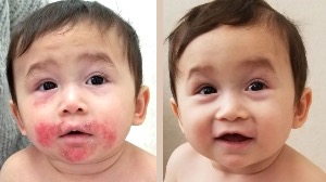 Viêm da cơ địa trên mặt và kết quả ấn tượng sau 3 tuần sử dụng HomoSAN