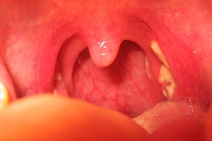 Lợi ích vượt trội của nước muối điện hoá HomoSAN trong điều trị viêm họng