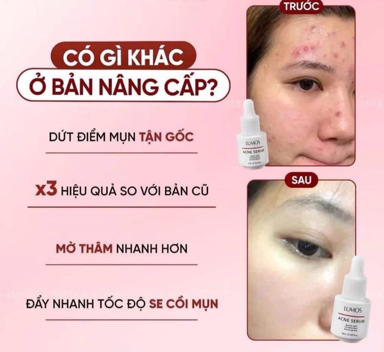 Serum Mụn Lumos Acne GC Nature USA, Lọ 5mL Giúp Ngăn Ngừa Và Làm Se Khô Nhanh Các Nốt Mụn Trên Da