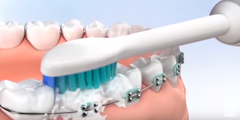 Bàn chải điện cho người niềng răng