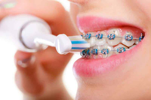 niềng răng dùng bàn chải điện