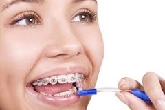 Invisalign – Niềng răng không mắc cài