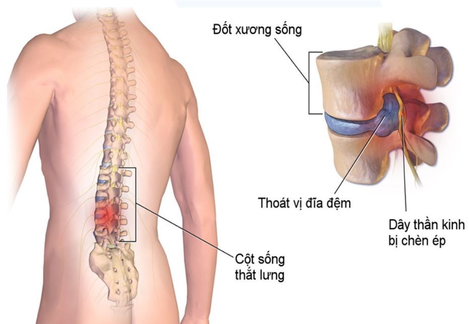 Bệnh vôi hóa cột sống và điều trị bằng vật lý trị liệu