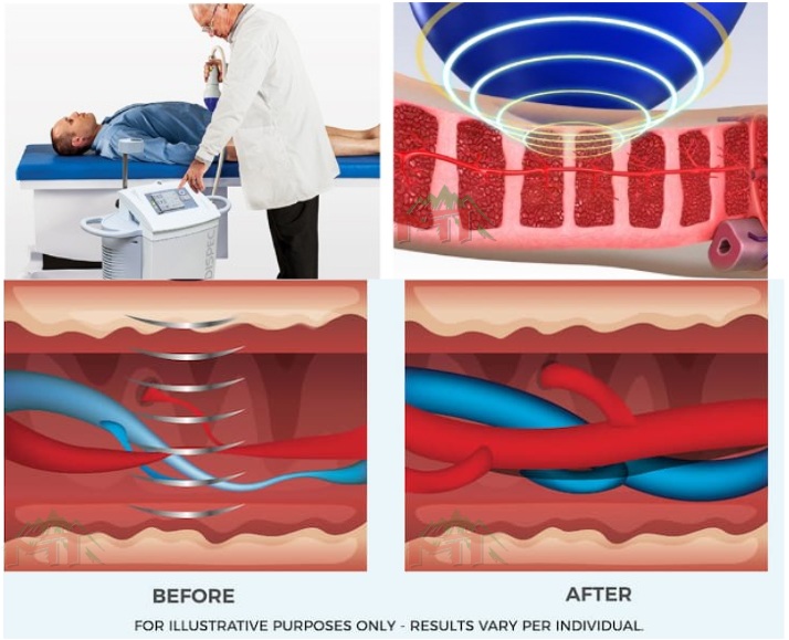 điều trị rối loạn cương dương bằng sóng xung kích