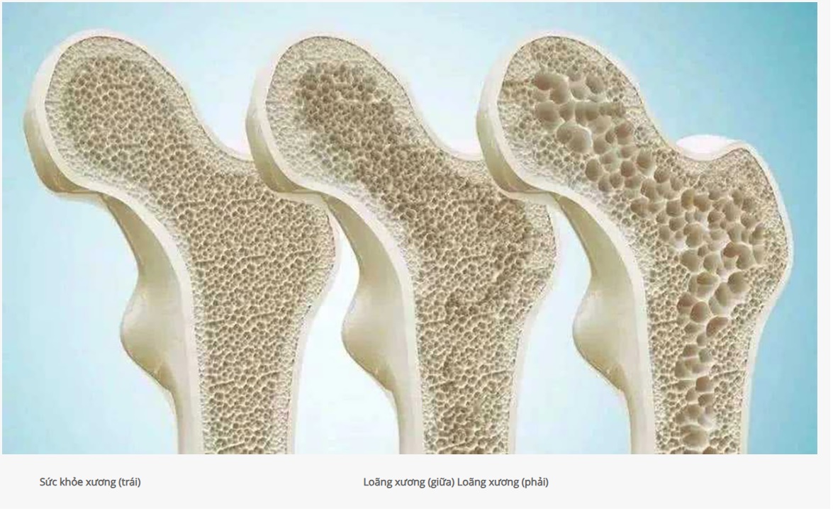 hình ảnh loãng xương