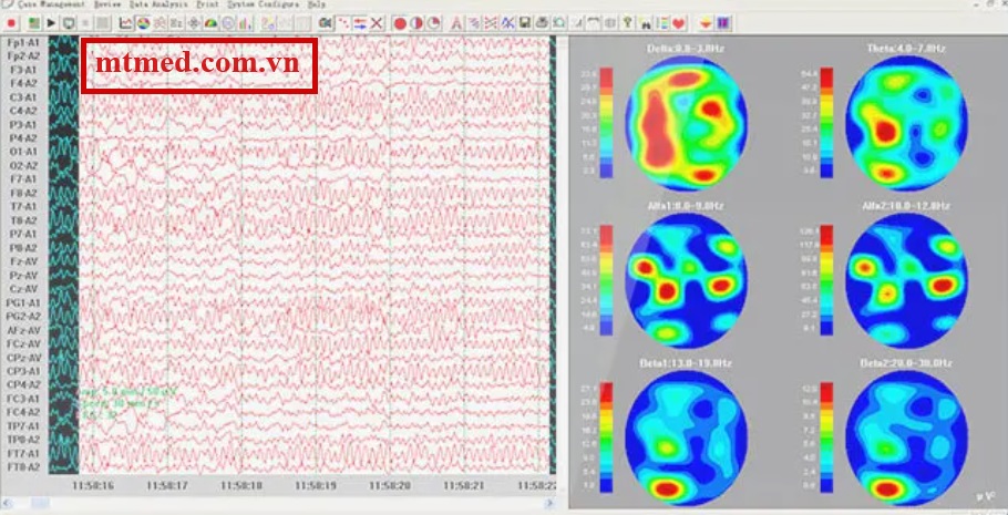 hình ảnh sóng điện não