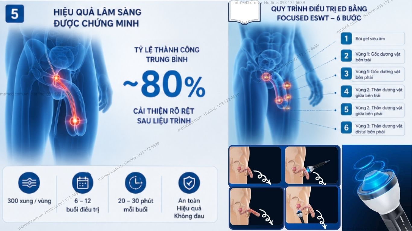 liệu pháp điều trị rối loạn cương dương bằng sóng xung kích