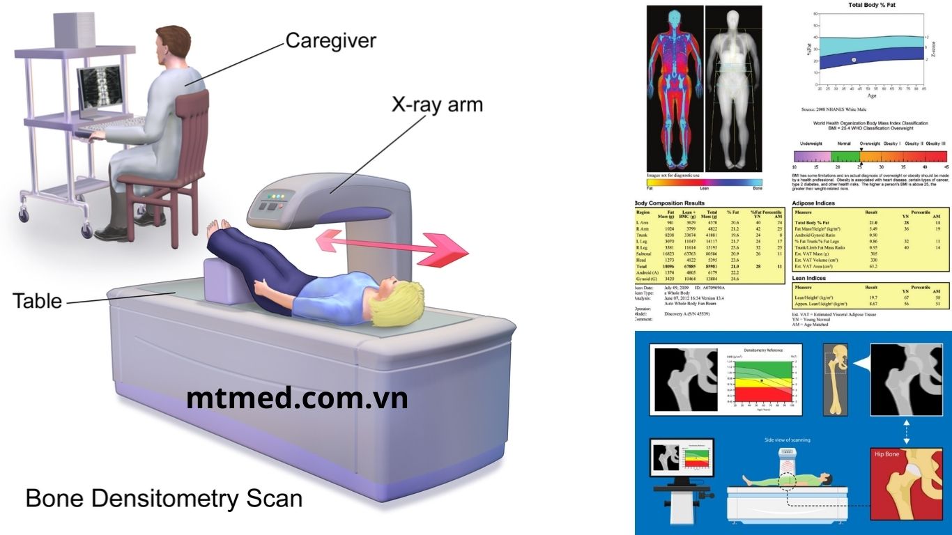máy đo loãng xương