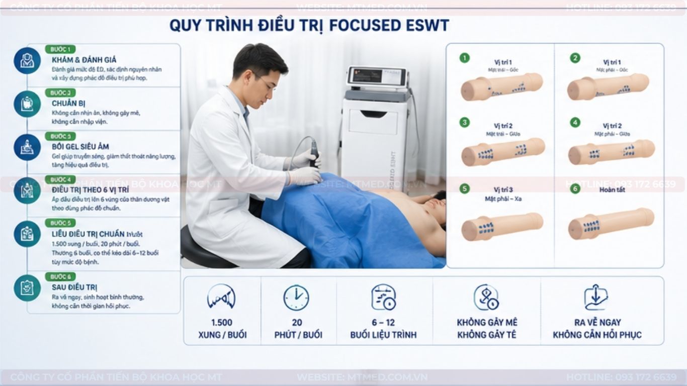 quy trình điều trị rối loạn cương dương bằng máy xung kích
