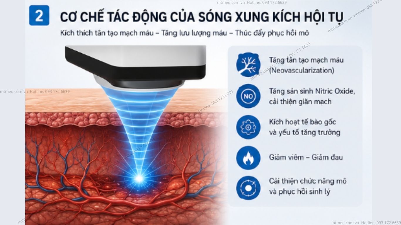 sóng xung kích trị liệu rối loạn cương dương