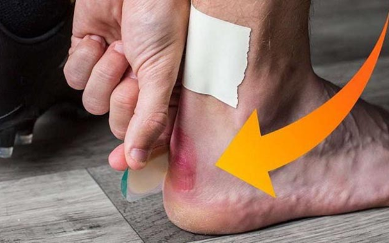 Mang giày bị đau gót chân: Nguyên nhân và cách khắc phục nhanh chóng