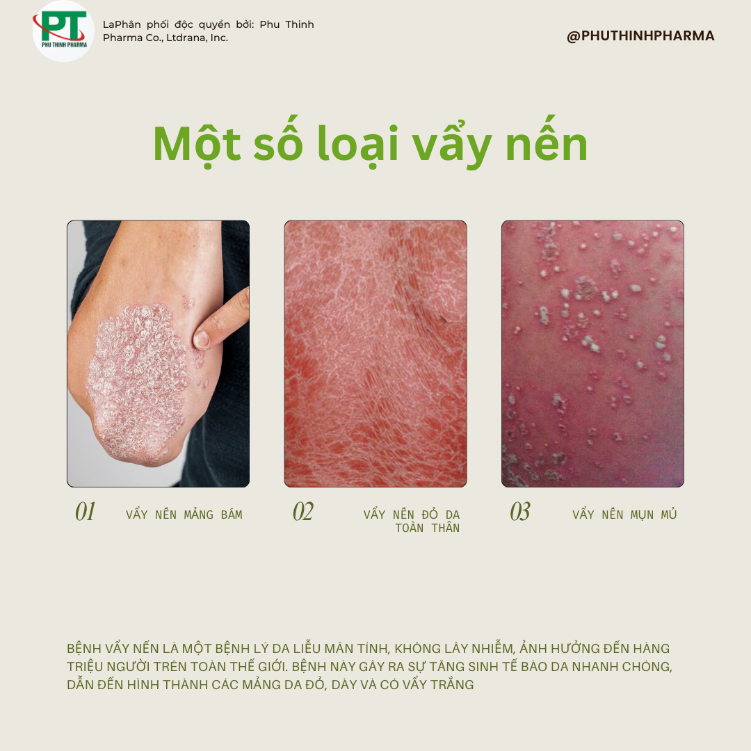 Bệnh Vẩy Nến Là Gì? Một số Loại Vẩy Nến Thường Gặp