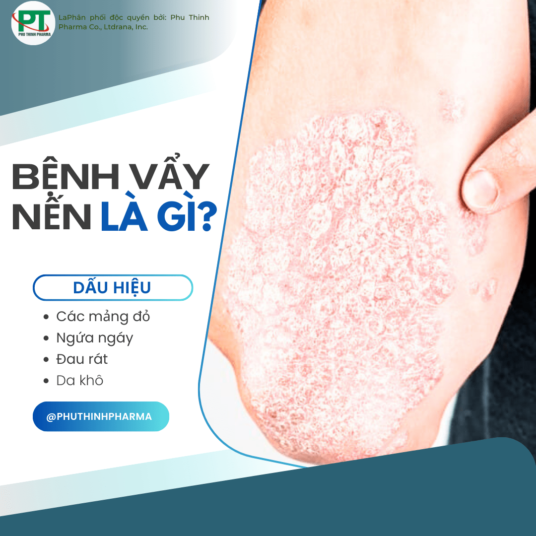 Bệnh Vẩy Nến Là Gì? Nguyên Nhân Và Dấu Hiệu Của Bệnh Vẩy Nến