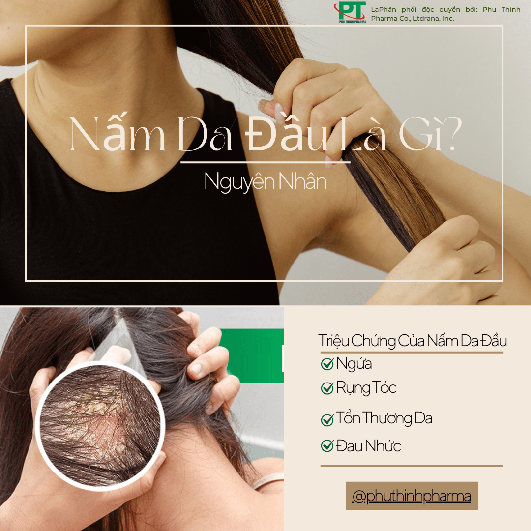Nấm Da Đầu Là Gì? Nguyên Nhân, Cách Điều Trị Và Phòng Ngừa