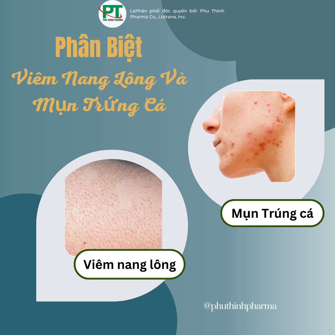 Phân Biệt giữa Viêm Nang Lông và Mụn Trúng Cá