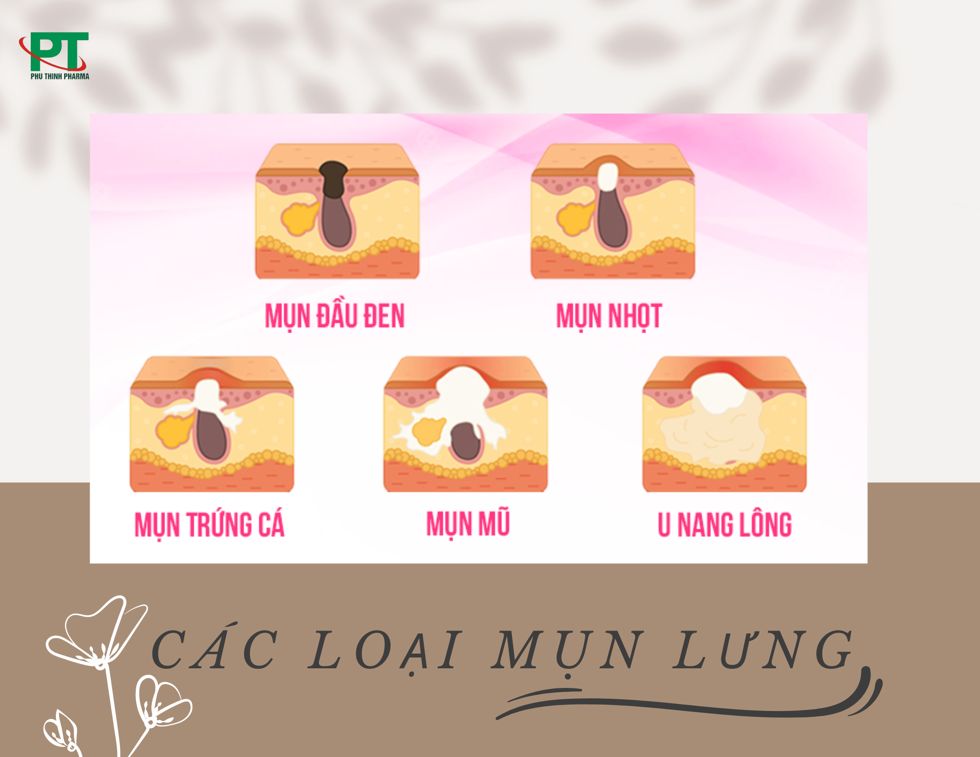 Các Loại Mụn Lưng Và Nguyên Nhân Xuất Hiện Mụn Lưng