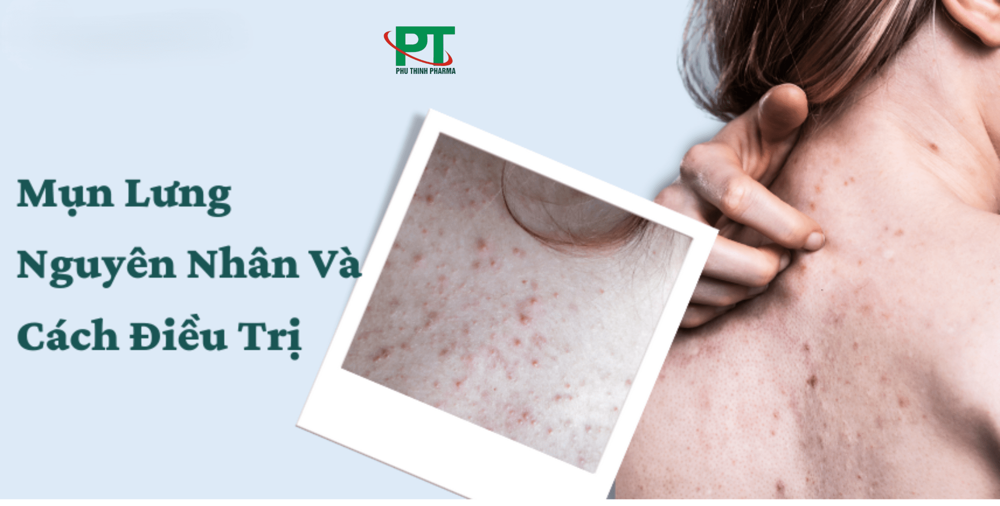 Vì Sao Lại Có Mụn Lưng: Nguyên Nhân và Cách Khắc Phục