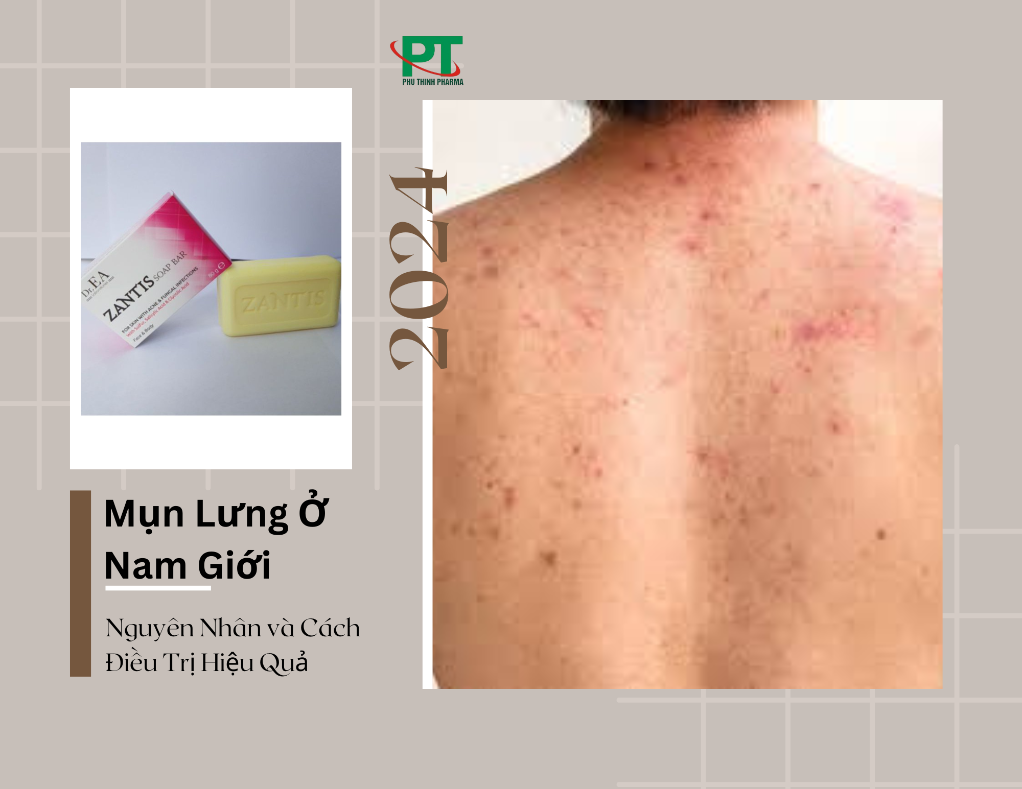 Mụn Lưng Ở Nam Giới: Nguyên Nhân và Cách Điều Trị Hiệu Quả