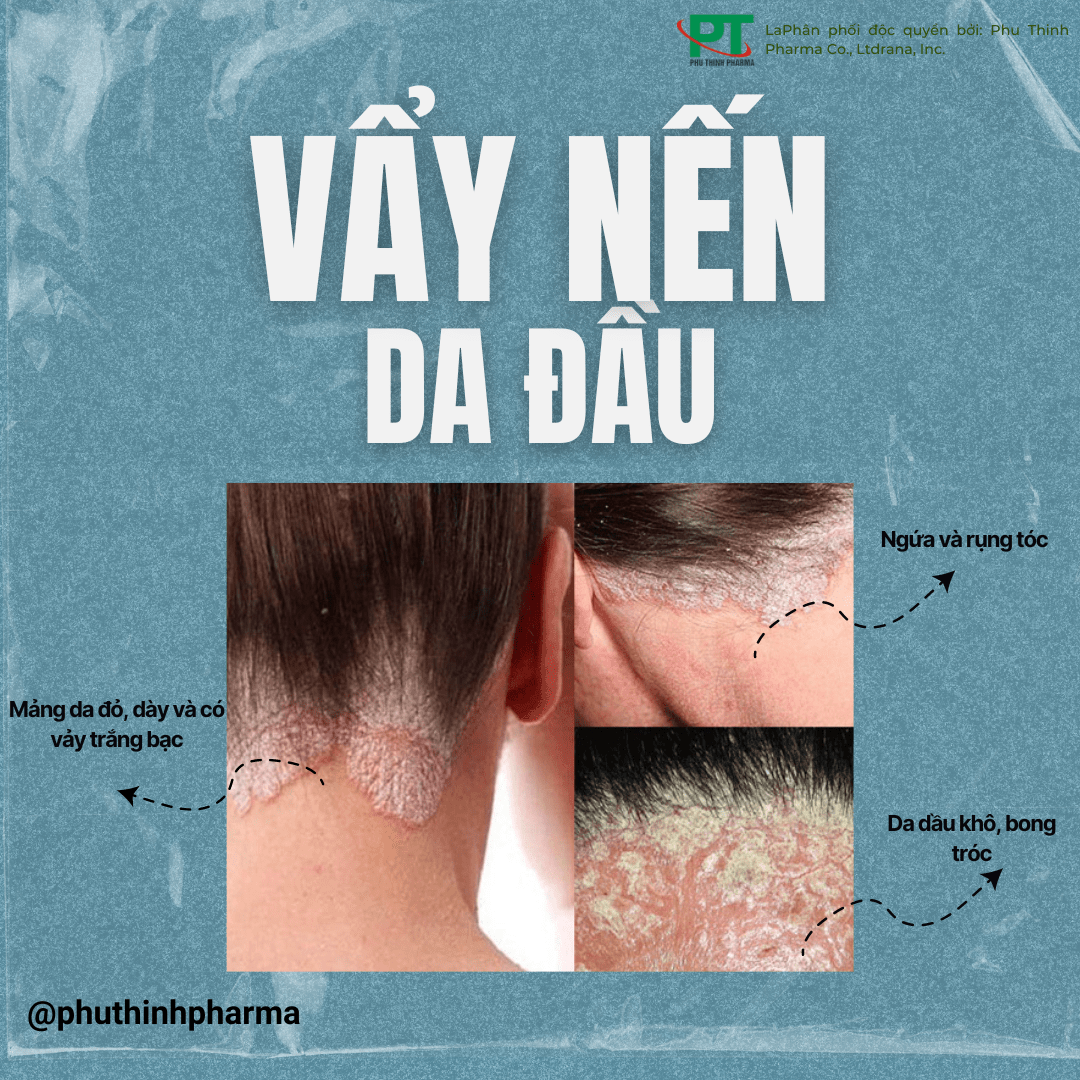 Bệnh Vảy Nến Da Đầu Là Gì? Có Lây Không Và Cách Chữa Như Thế Nào?